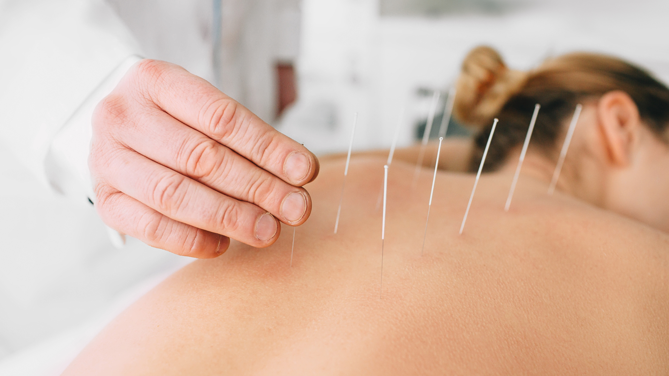 You are currently viewing Acupuncture and Mental Health: A Complementary Approach to Wellness